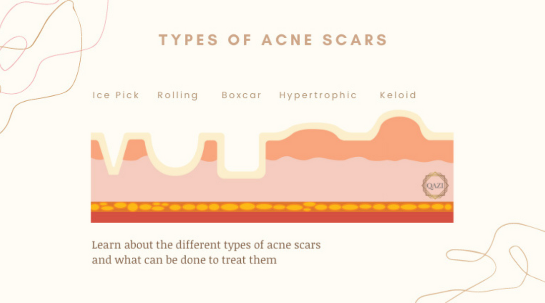 Types Of Acne Scars