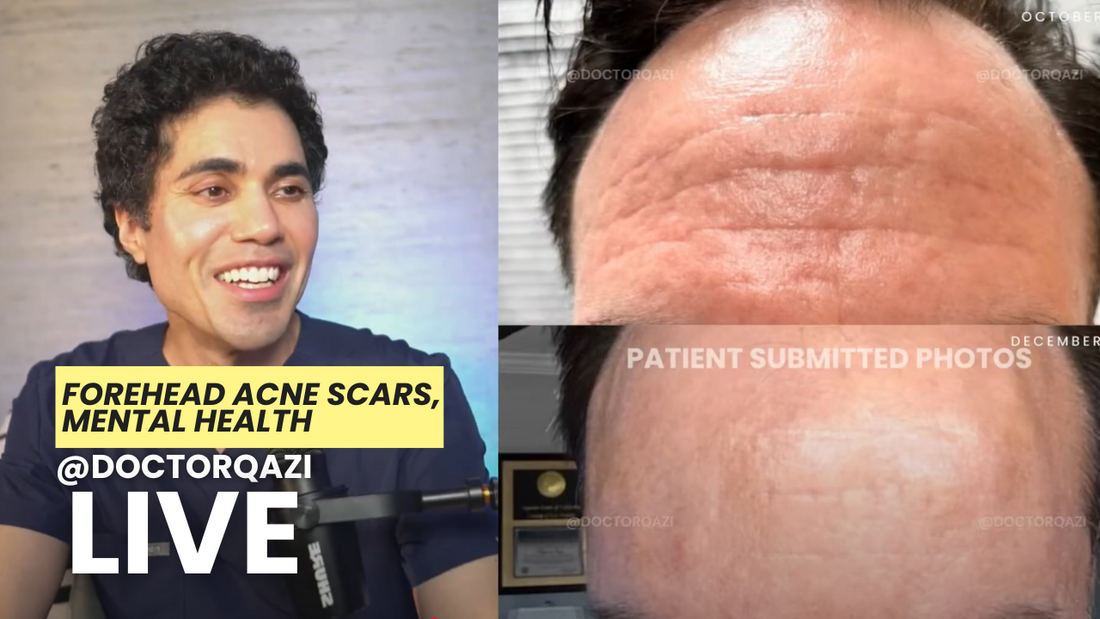 forehead scars
