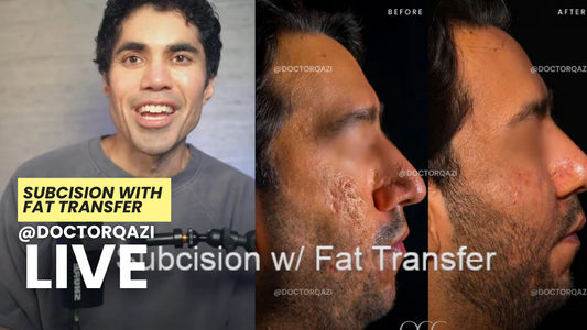 Subcision with Fat Transfer