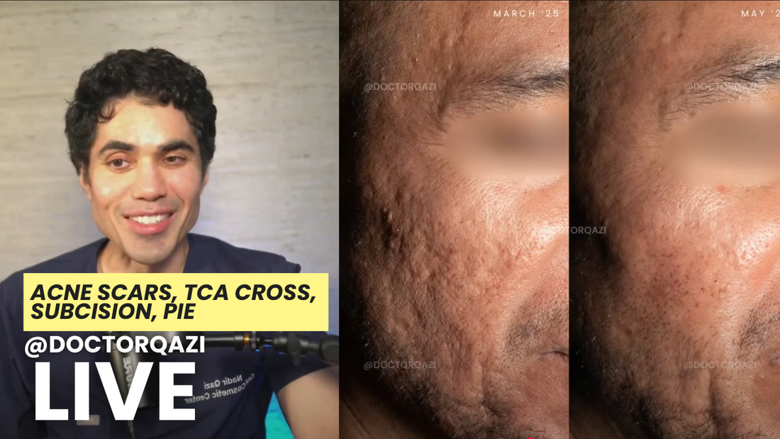 atrophic scarring