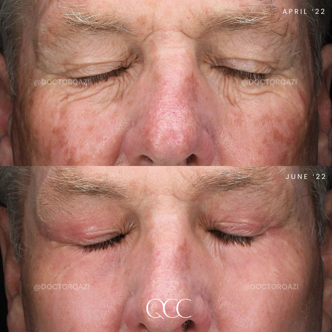 anti-aging