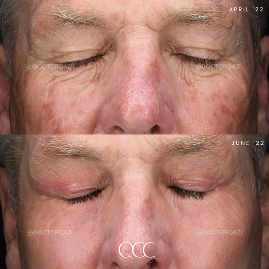 anti-aging