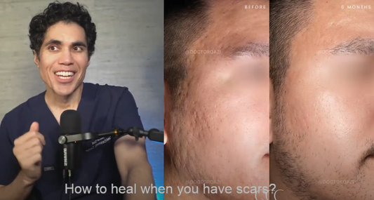 acne scars