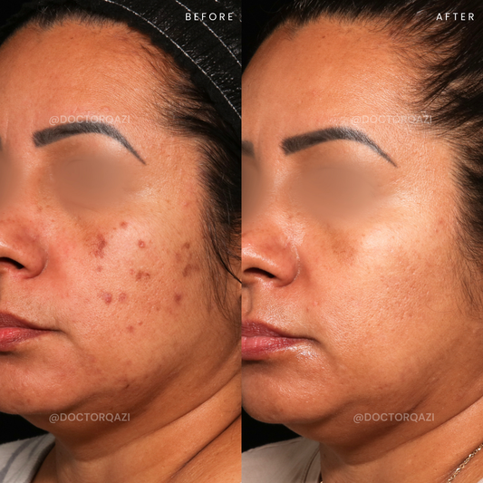 pico laser for pih