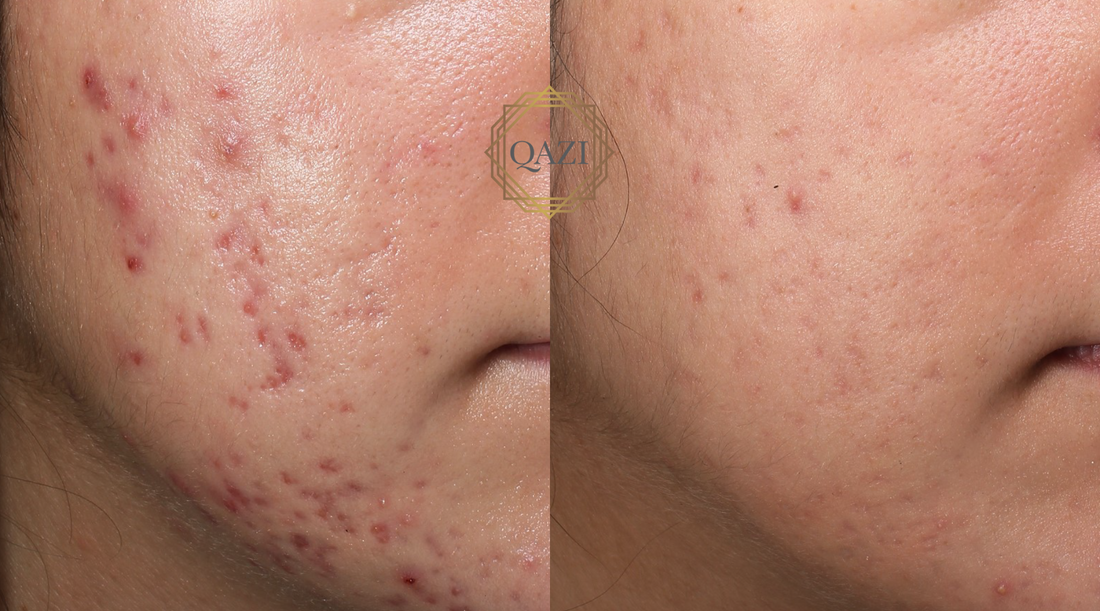 Accure Laser Treatment for Acne