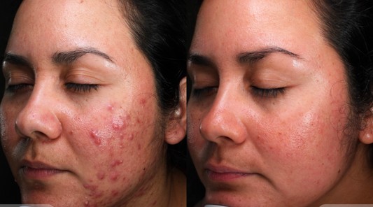 Is Accure Laser Better Than Accutane For Active Acne?