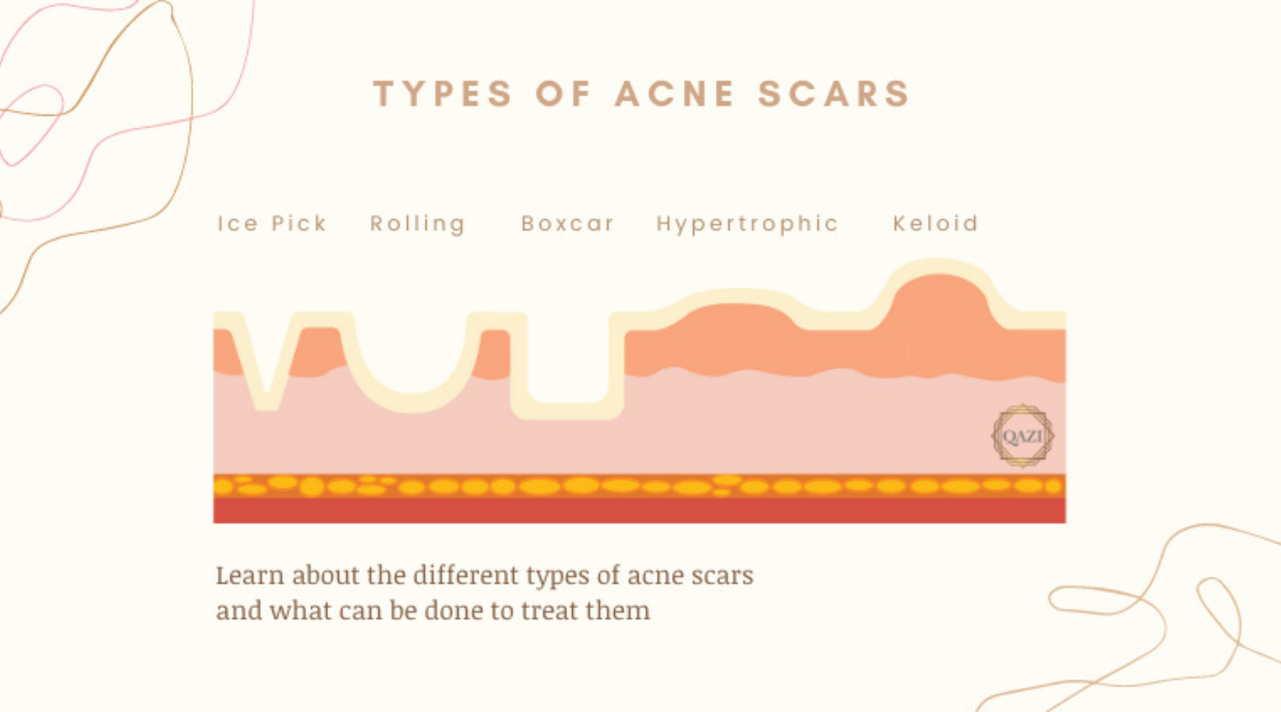 Types Of Acne Scars – Qazi Cosmetic Center