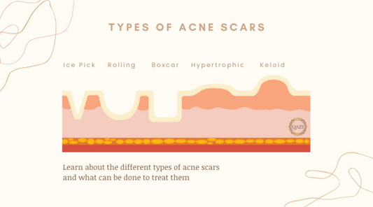 Types Of Acne Scars