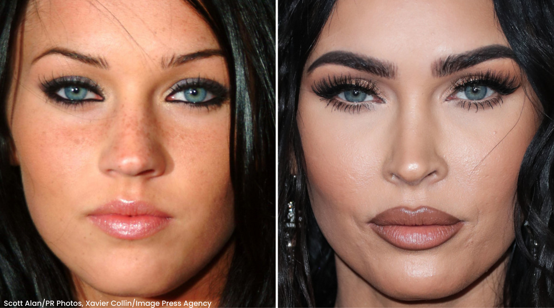 Does Megan Fox Use Fillers?