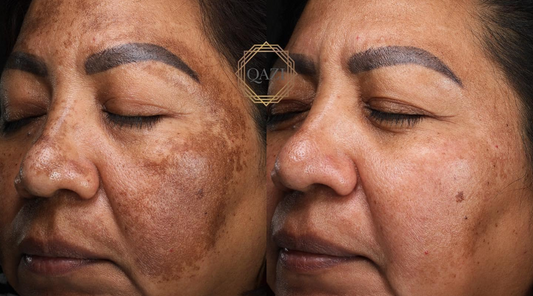 Pico Laser Treatment for Hyperpigmentation