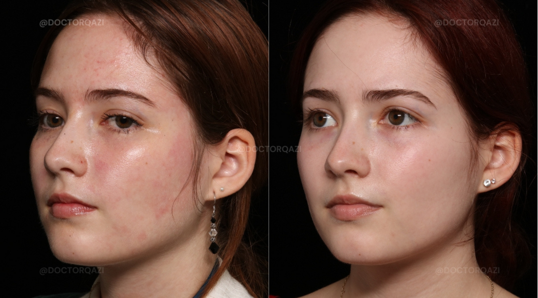 Rosacea Laser Treatment with Excel V