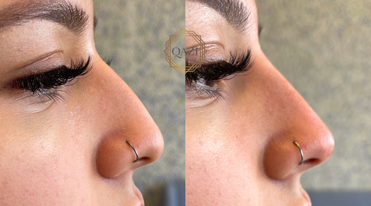 What Is a Non-Surgical Nose Job?