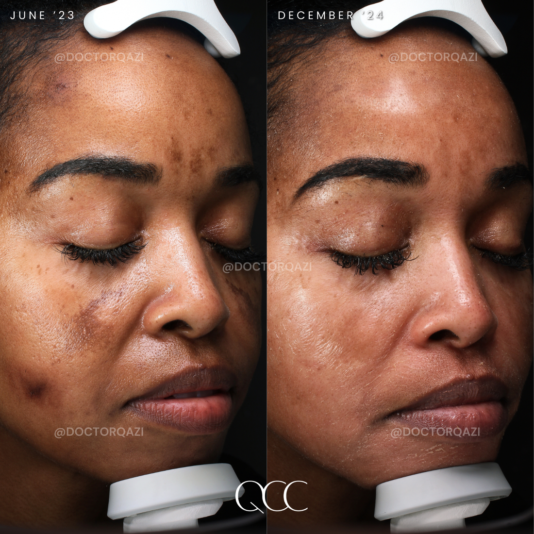 melasma