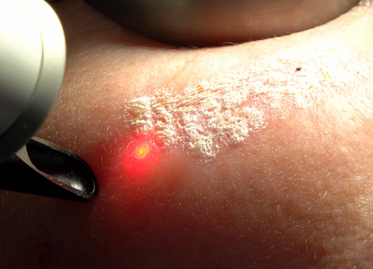 Laser facials