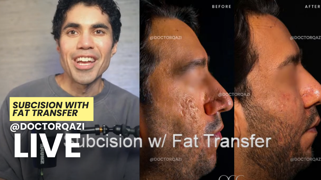 Subcision with Fat Transfer