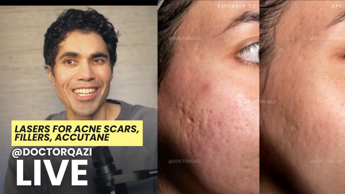Lasers for Acne Scars