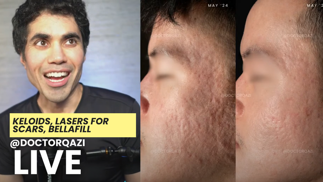 Keloids