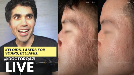 Keloids