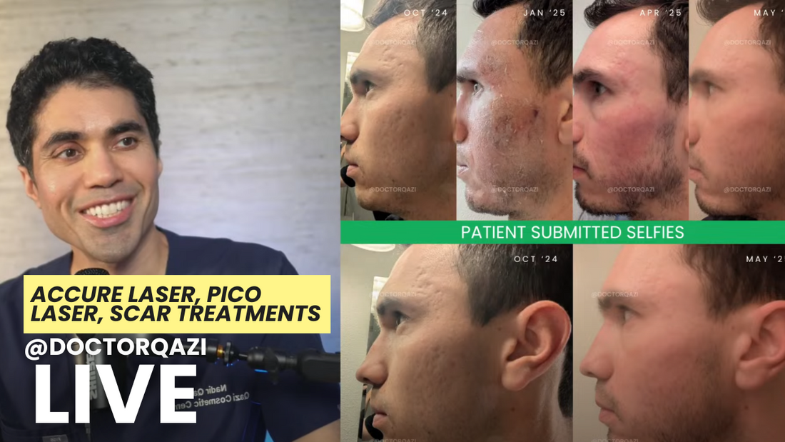 acne scar treatments