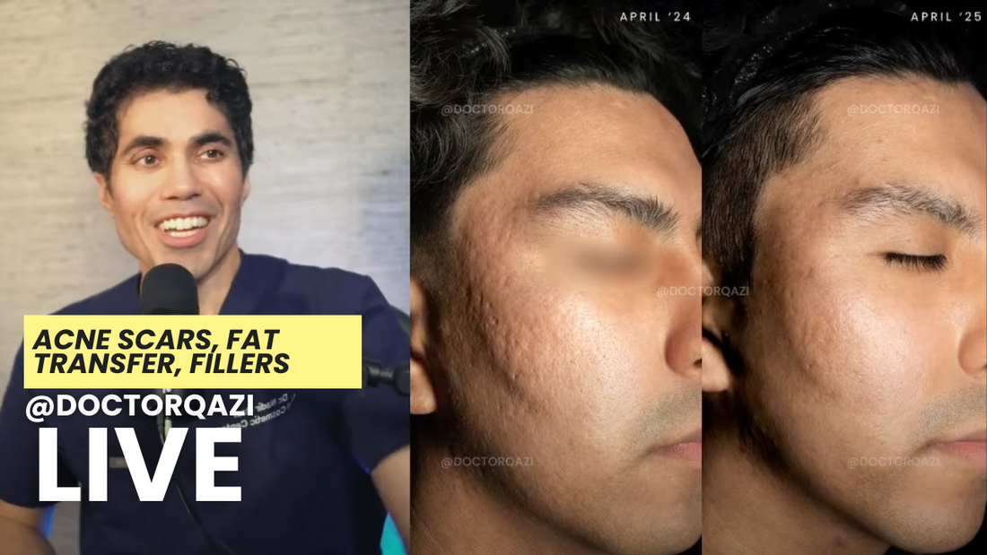 fat transfer
