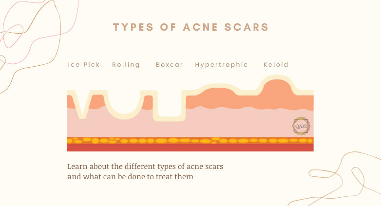 Acne Scar Treatments