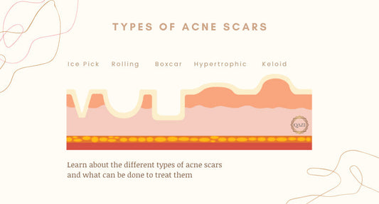 Acne Scar Treatments