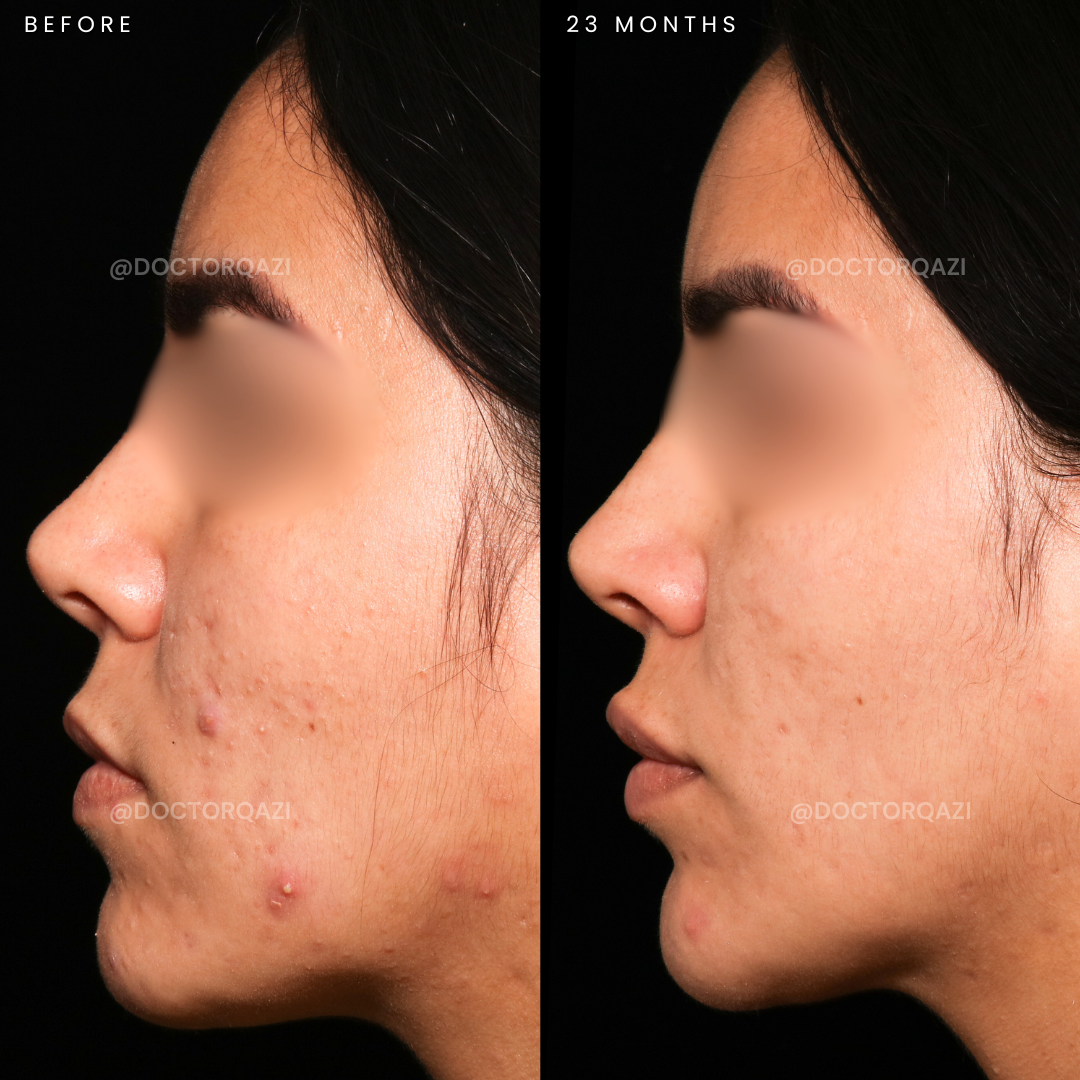 Fungal Acne