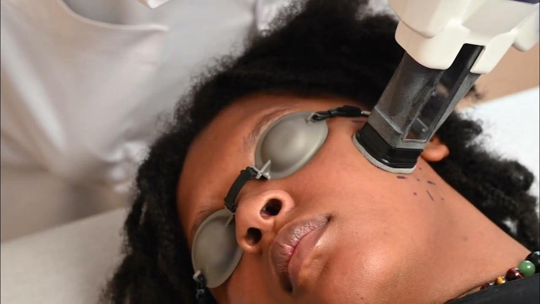Laser Treatment for Acne