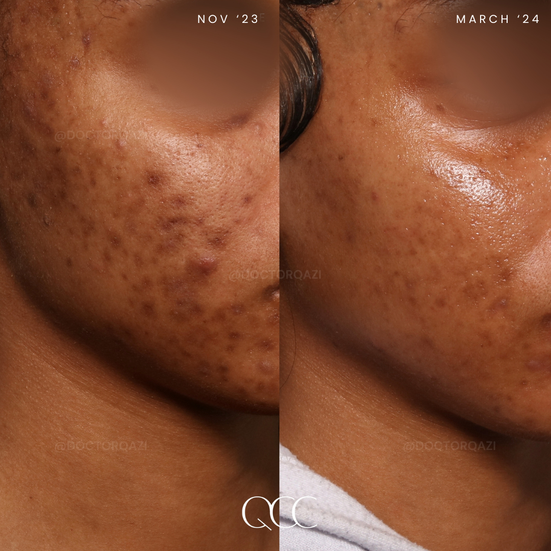 Post-Inflammatory Hyperpigmentation
