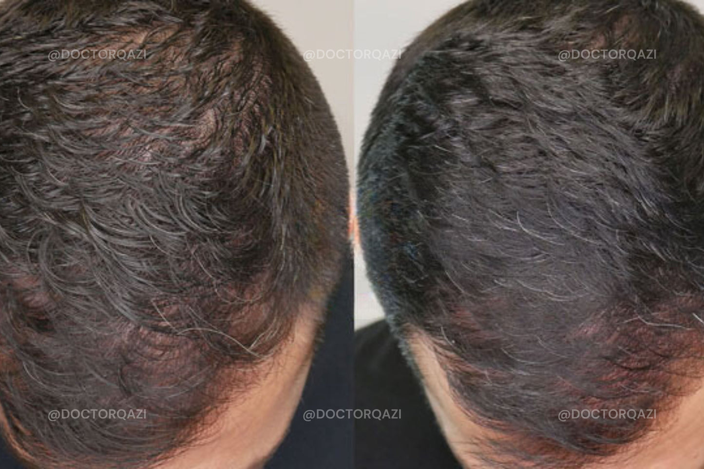 PRP Hair Repair - PRP Treatment