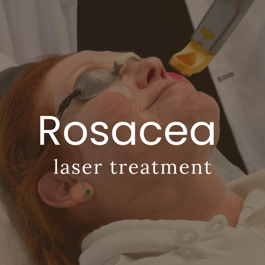 Rosacea Laser Treatment