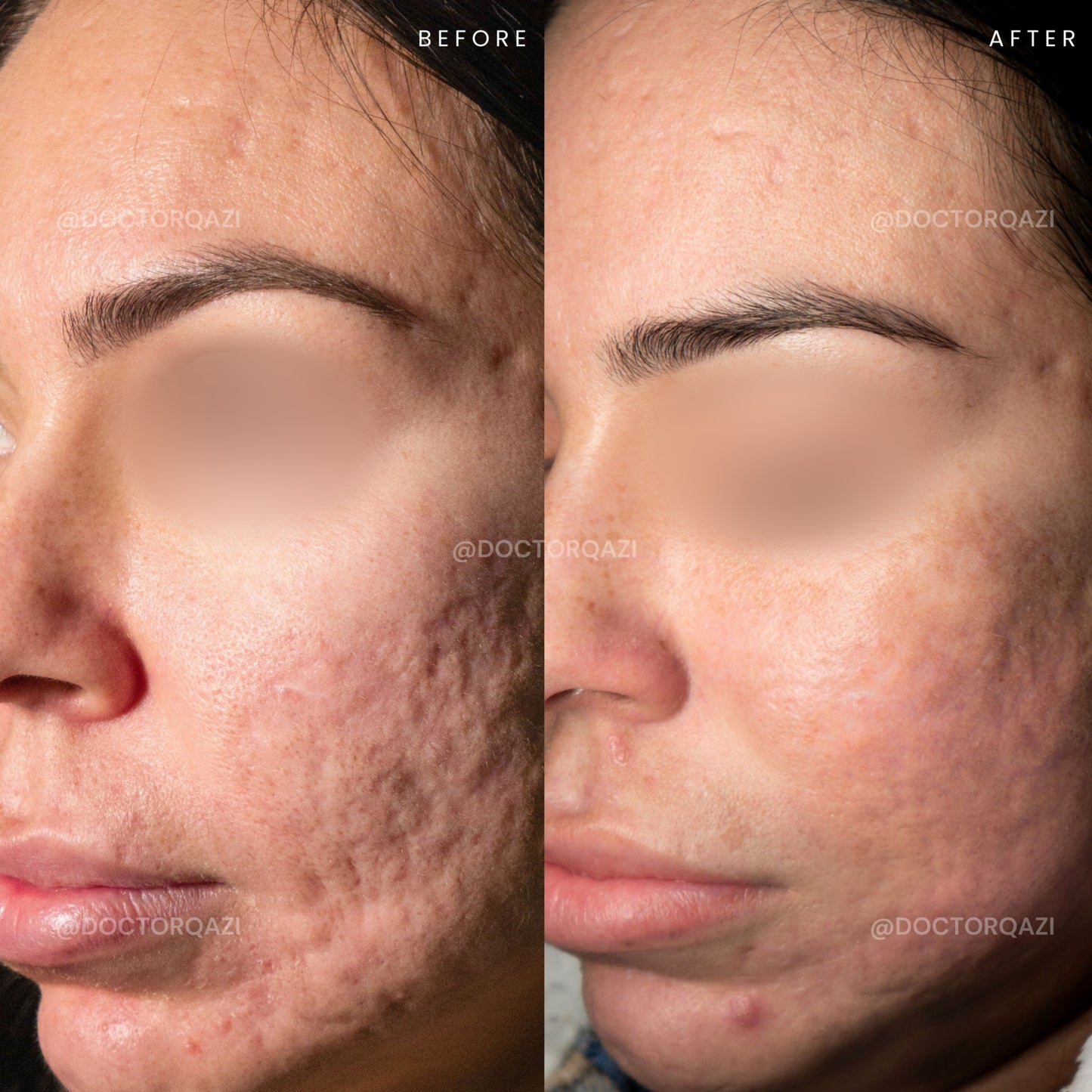 Acne Scar Consultation with Dr. Qazi