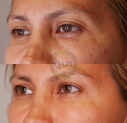 Undereye Filler with Hyaluronic Acid