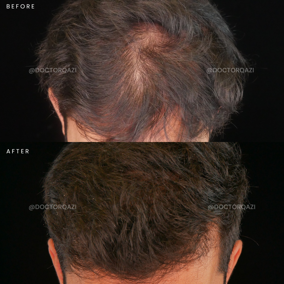 PRP Hair Repair - PRP Treatment