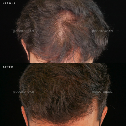 PRP Hair Growth Treatment - One Session