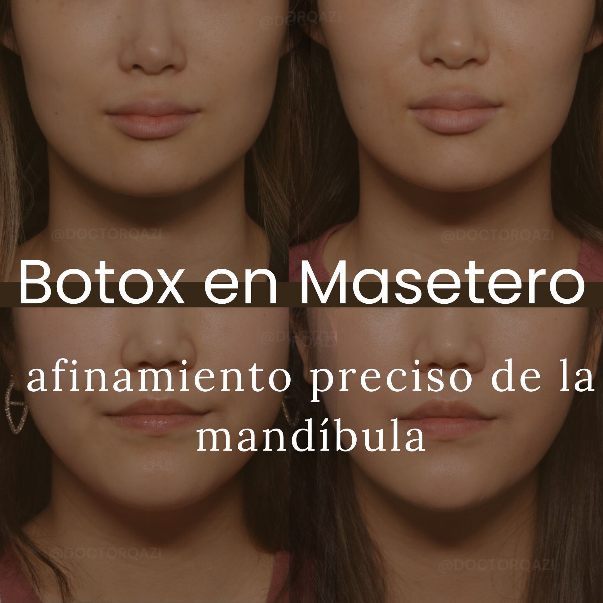 Botox En Masetero Qazi Cosmetic Center