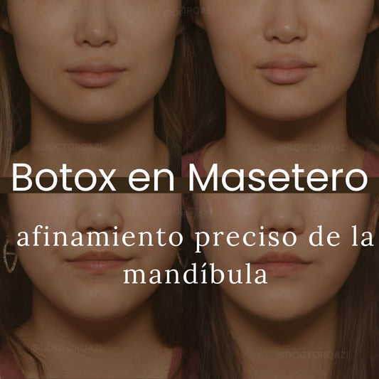 Botox en Masetero