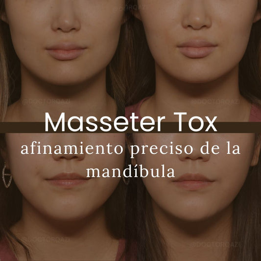 Academia Qazi - Masseter Tox