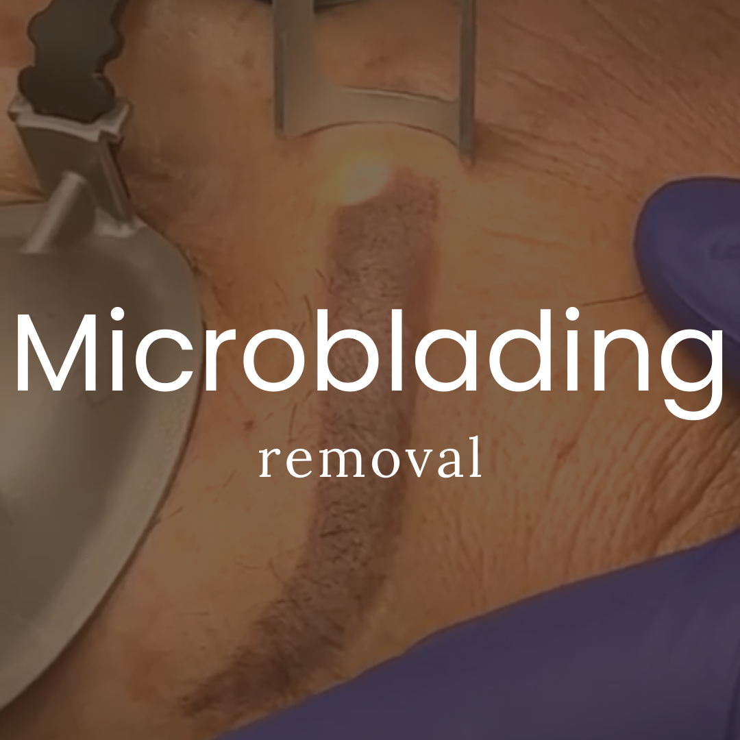 Microblading Removal