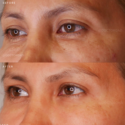 PRP Therapy for Undereye Dark Circles