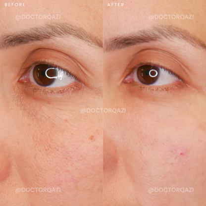 PRP Therapy for Undereye Dark Circles