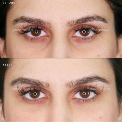 PRP Therapy for Undereye Dark Circles