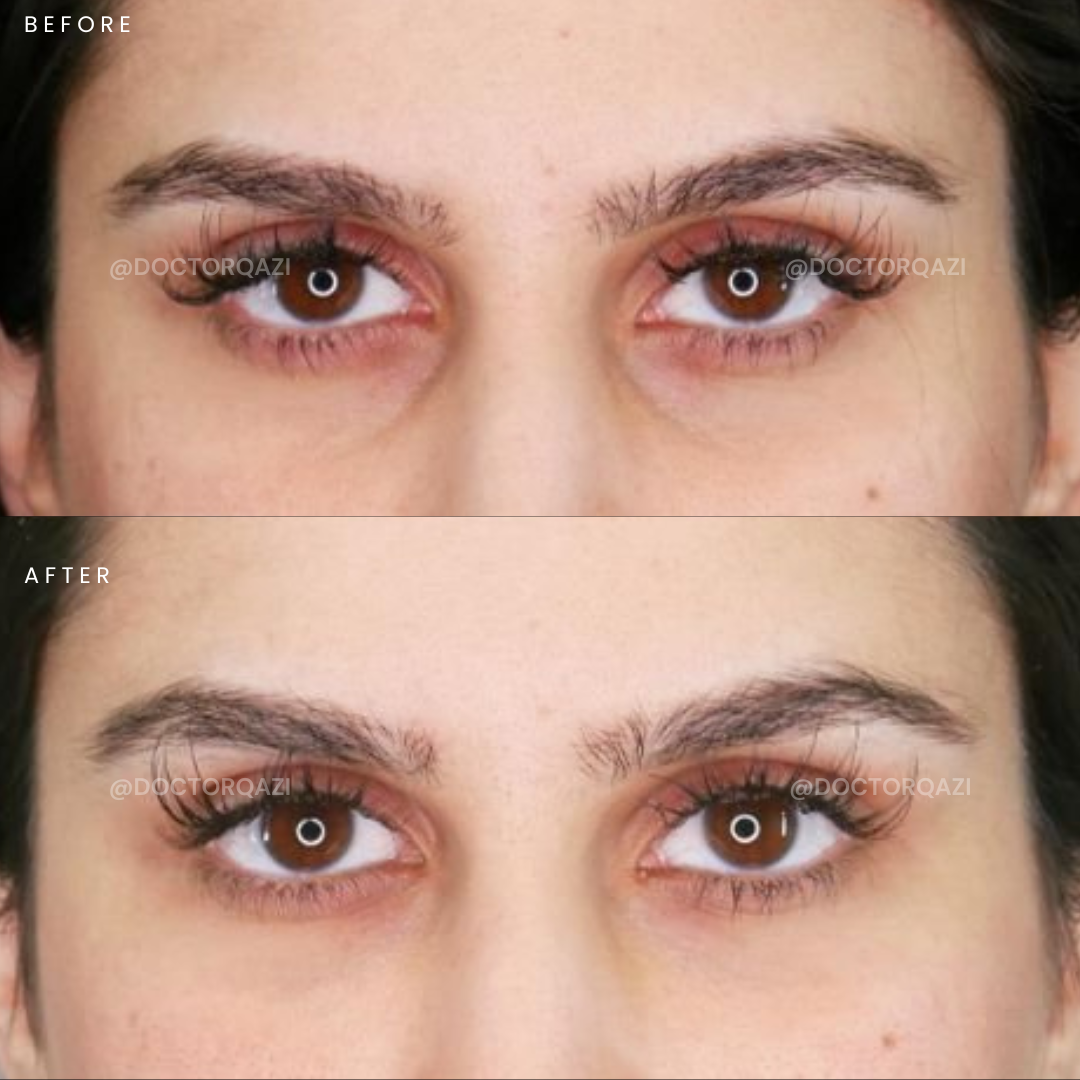 PRP for Undereyes - Sapphire Pricing