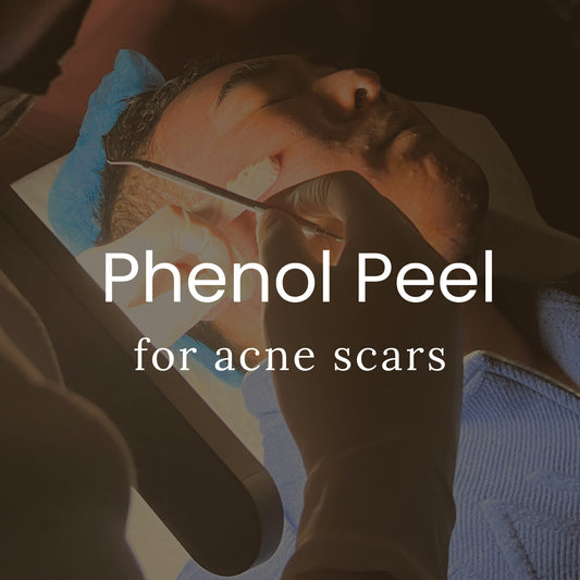 Phenol Peel (2-Step Peel for Acne Scars)