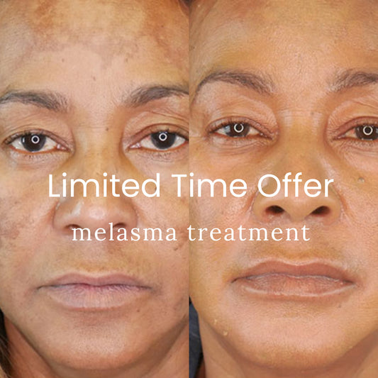 MELASMA TREATMENT - LIMITED TIME OFFER