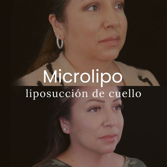 Microlipo - Para Cuello