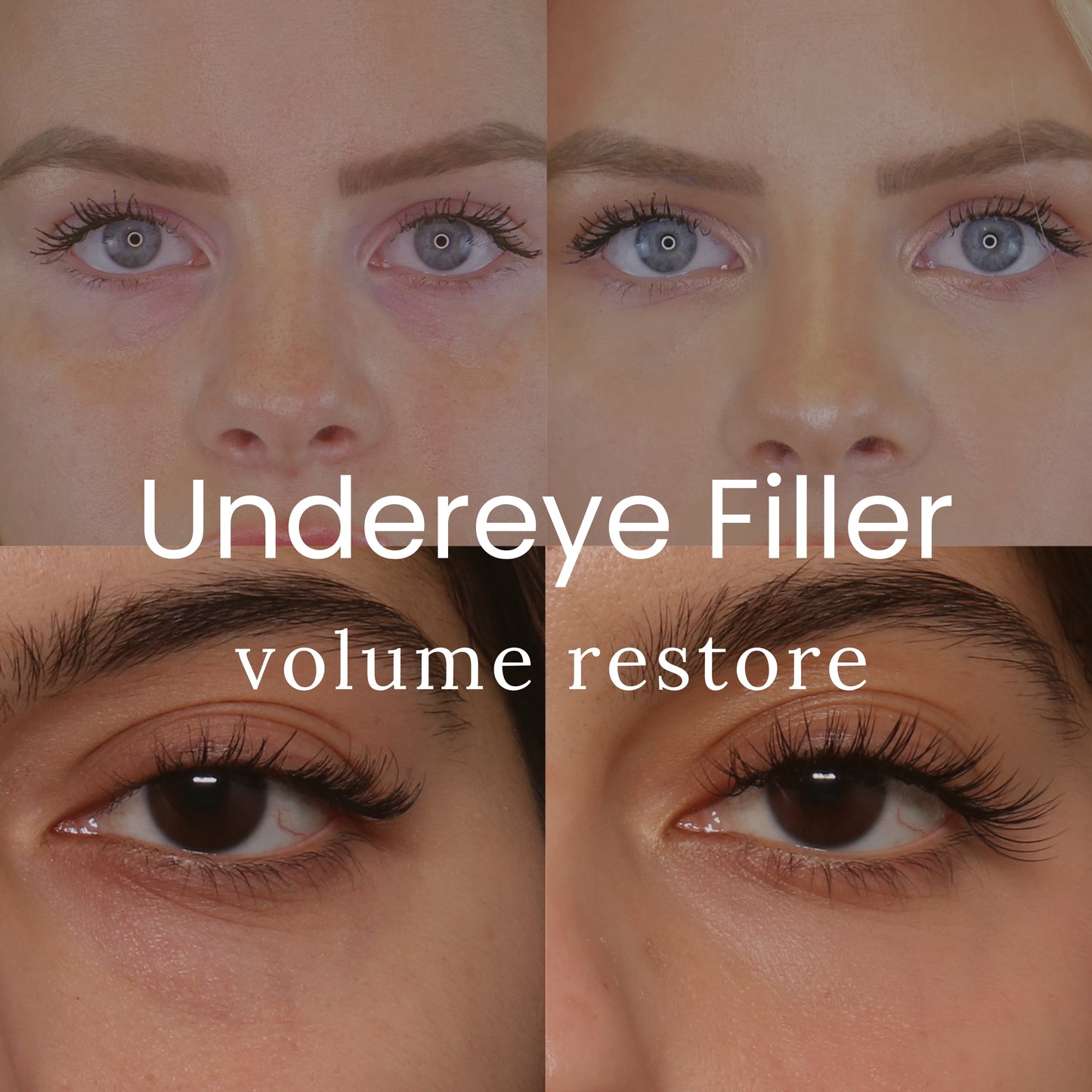 Undereye Filler - Crystal Pricing