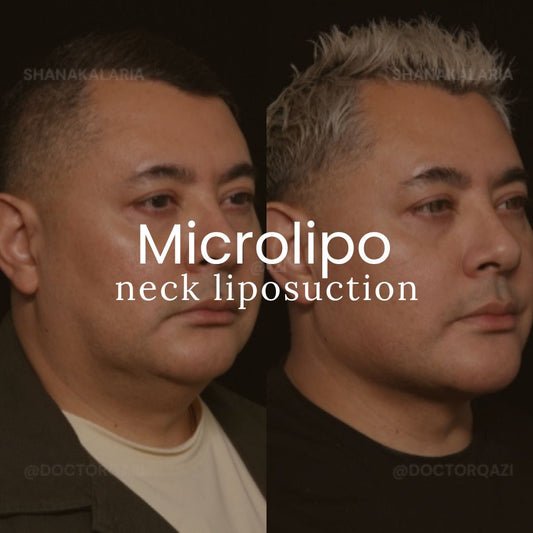 Microlipo Neck Liposuction without General Anesthesia