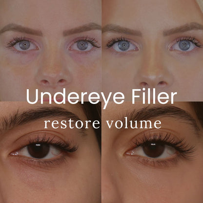 Undereye Filler with Hyaluronic Acid