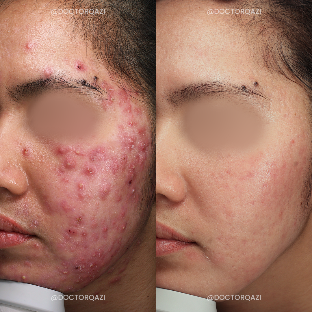 Accure Acne Laser Treatment